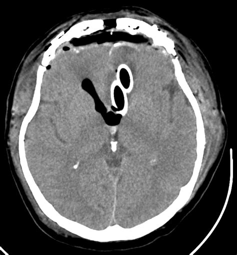 Nasopharyngeal Airway In Brain