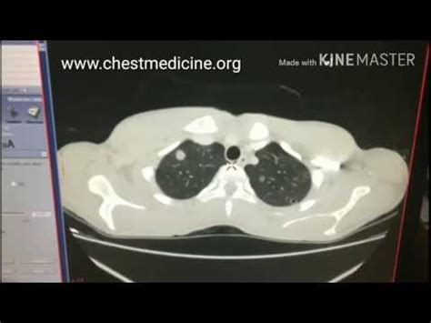 Chest Medicine Made Easy Dr Deepu Septic Pulmonary Embolism