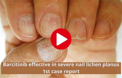 Barcitinib Effective In Severe Nail Lichen Planus 1st Case Report