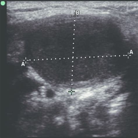 Gray Scale Color Doppler Ultrasound Image Of Roundshaped Mitotic