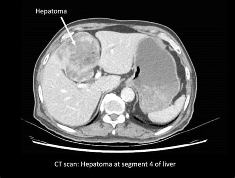 Liver Cancer Treatment In Singapore Ls Lee Surgery Clinic