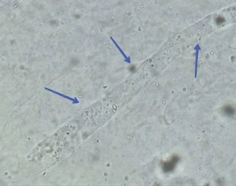 Cylindre Hyalin Définition Causes et Signification clinique