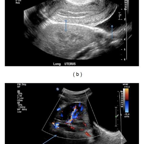 Laparoscopy A Pelvic Kidney Superiorly With A Ruptured Tubal Ectopic