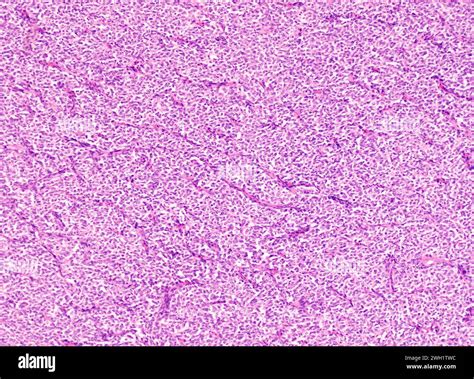 Clear cell sarcoma of kidney, light micrograph Stock Photo - Alamy