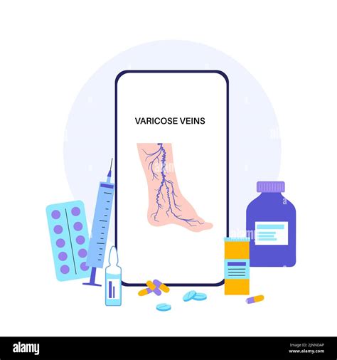 Varicose Vein Treatment Illustration Stock Photo Alamy