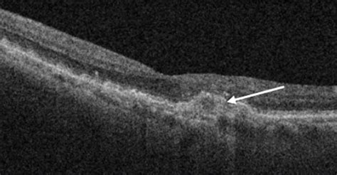 Age Related Macular Degeneration Viewpoint