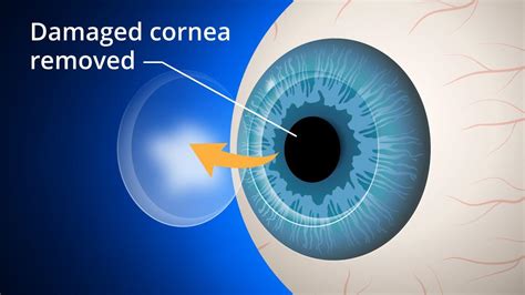 Cornea Treatment Specialist In Indore Best Corneal Surgery Results At