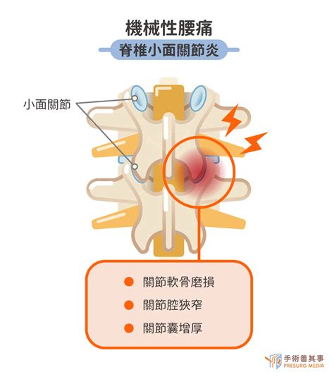 脊椎手術治療椎間盤突出、脊椎滑脫：手術原理、費用、後遺症