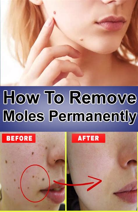 How To Remove Moles Naturally Mole Removal Moles On Body How To Remove