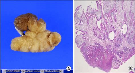 Hyperplastic Polyp Gross