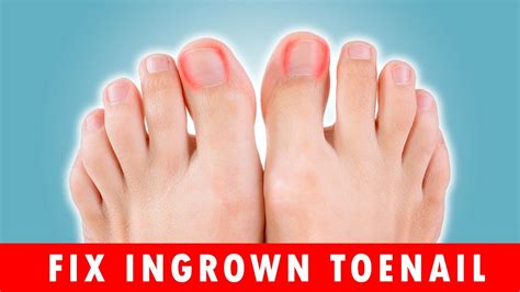 How To Fix Ingrown Toenails At Home Youtube