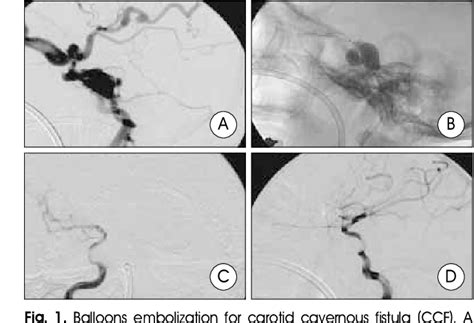 Figure 2 From Endovascular Treatments Of Traumatic Carotid And