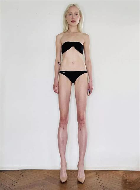 Theresia Fischer spent a crore to increase the length of her legs ...