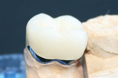 Inlays And Onlays Baluke Dental Studios