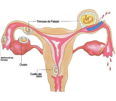 異所性妊娠とは何ですかその定義と意味 健康 2024