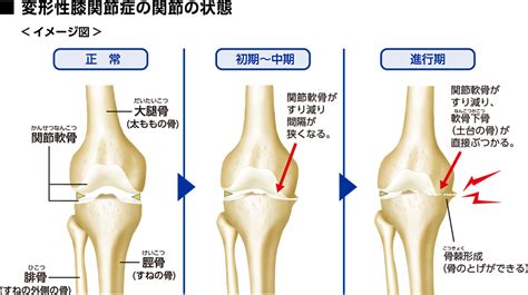 変形性膝関節症ってどんな病気？｜よくわかるほねとひざ