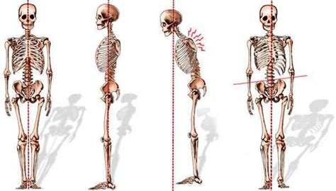 Spinal Deformities - Dr. Paul C. McCormick