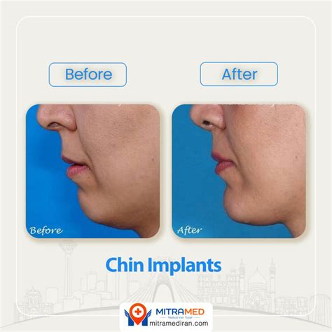 Chin Implants Before and After Photos | MITRAMED