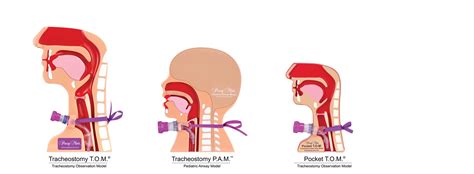 Education - Passy-Muir (improving patient's quality of life with education)