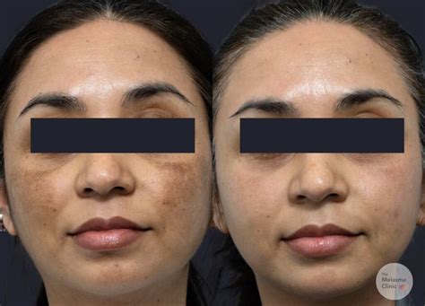 Best Melasma Lasers Treatments In Australia Dr Davin Lim