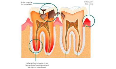 Fisura Dental E Infección on Sale smarys org