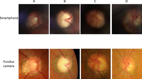 Deep Learning Assisted Automatic Diagnosis Of Glaucoma Using A