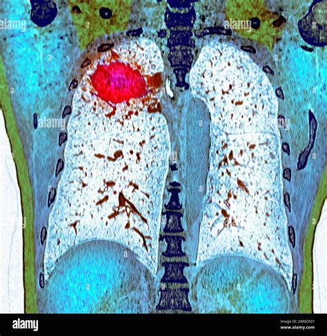 Lung cancer, CT scan Stock Photo - Alamy