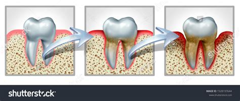 Tooth Gums Inflammation Disease Medical Dental Stock Illustration