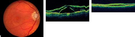 Macular Schisis And Detachment Associated With Presumed Acquired