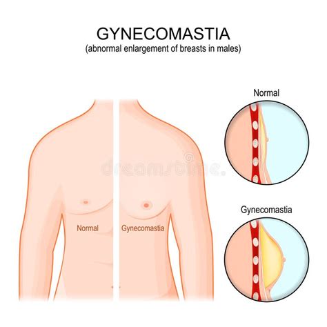 Gynecomastia Torso Of Healthy Man And Abnormal Enlargement Of Breasts