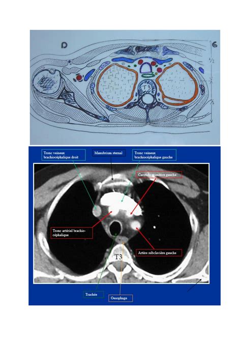 SOLUTION Coupes Tag Es Du Thorax Coeur Studypool