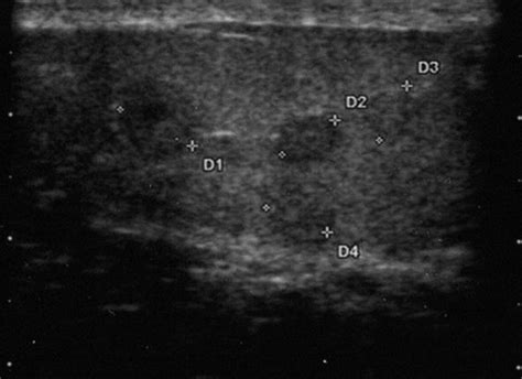 Testicular Adrenal Rest Tumors In Patients With Congenital Adrenal