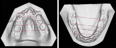 Corticotomy Assisted Rapid Maxillary Expansion A Novel Approach With A