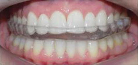 Occlusal Splint Therapy In Tmd Pain Management A Review Journal Of