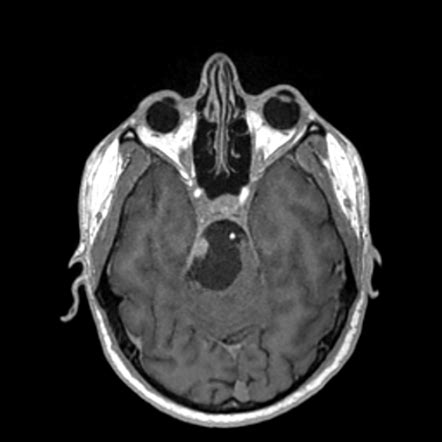 Trigeminal Cystic Schwannoma Image Radiopaedia Org