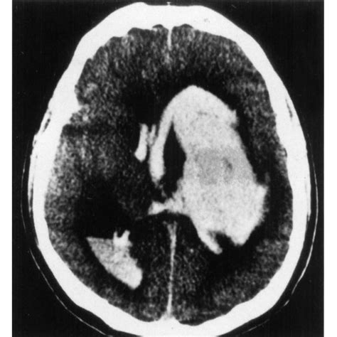 Pdf Basal Ganglia Herniation Into The Fourth Ventricle