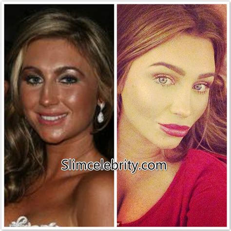 Lauren Goodger Plastic Surgery £6k 34e Breast Implants Nose Job And