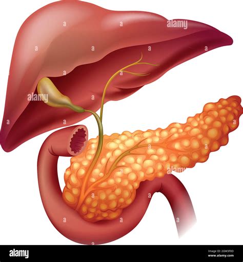 Pankreas Krebs Diagramm Im Detail Stock Vektorgrafik Alamy