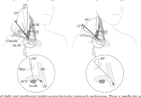 Subclavian Vein Central Line Landmarks