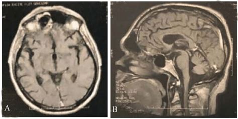 Postoperative Mri With Contrast Showing Total Removal Of Ogm