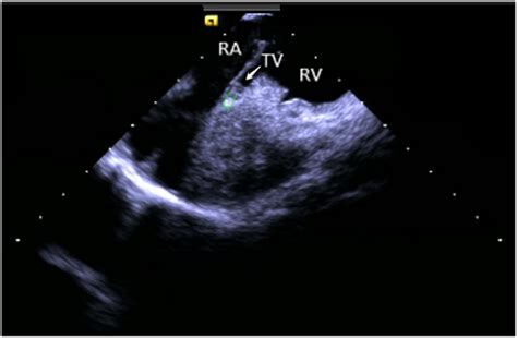 Figure 4 From Understanding The Scope Of Intracardiac Echocardiography