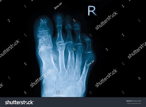 Xray Right Foot Show Fracture Big Stock Photo 490252486 | Shutterstock