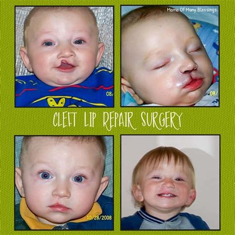 Cleft Palate Repair Before And After