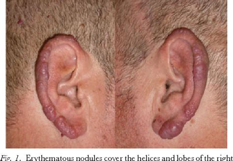 Figure 5 From Bilateral Cauliflower Ear As The Presenting Sign Of B