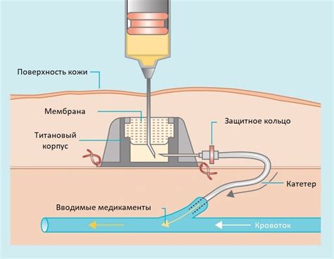 Капельница медицинская устройство схема и принцип действия - Фото ...