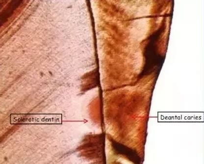 Enamel Dentin And Cementum Unit Flashcards Quizlet