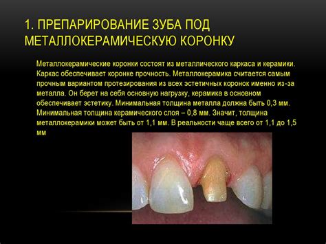 Технология изготовления металлокерамической коронки - презентация онлайн