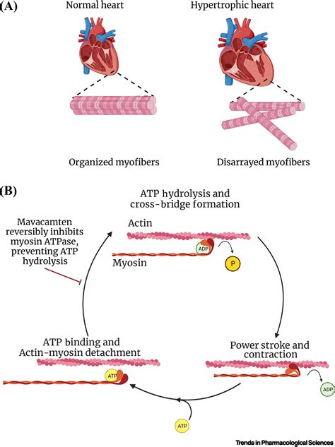 Mavacamten Improves Symptoms In Obstructive Hypertrophic Cardiomyopathy