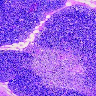 Thymic hyperplasia in a 26 year old boy who completed chemotherapy... | Download Scientific Diagram