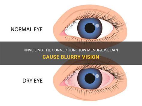 Unveiling The Connection How Menopause Can Cause Blurry Vision Medshun